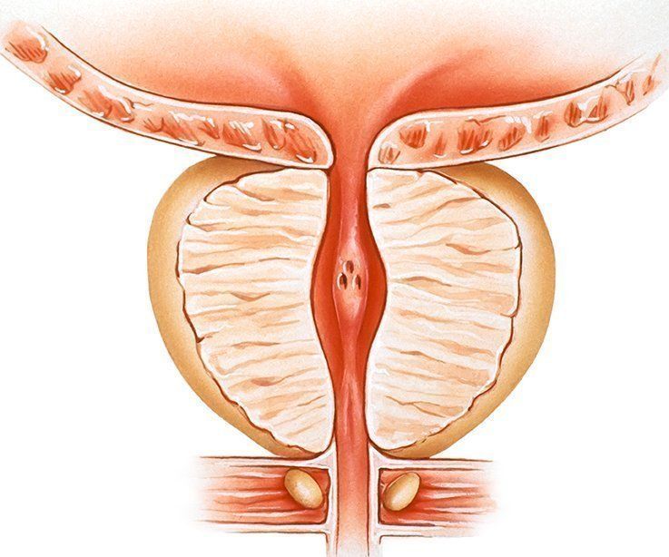 Аденома простаты: причины, симптомы, лечение